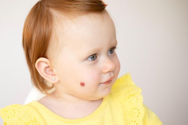 Hemangiomas